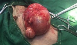 疝气手术可以吃瓜吗,疝气手术患者可否食用瓜果的探讨