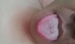 吃瓜舌头裂出血,揭秘吃瓜舌头裂出血的惊人真相