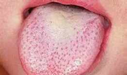 吃瓜舌头裂出血,揭秘吃瓜舌头裂出血的惊人真相